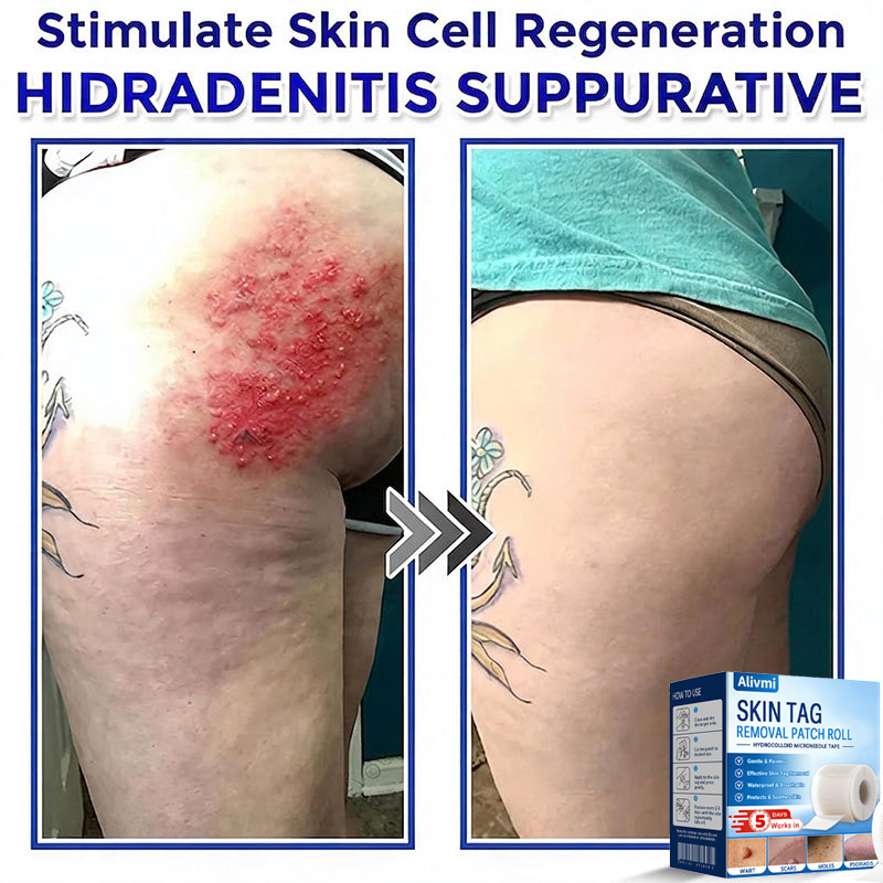 🔥 Final Hours! Save 78% on Alivmi® Microneedle Hydrocolloid Patch Roll – Limited Stock: 58 Units Remaining!